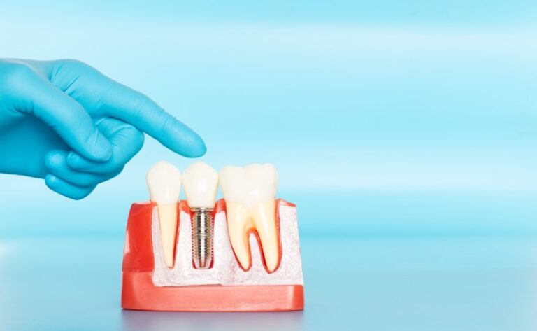 a dental implant and post in a cutaway jaw model.