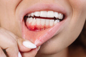 IMG META Close up of a ulcerative stomatitis on the gums. Gum inflammation. Cropped shot of a young woman showing red bleeding gingiva with an ulcer. Dentistry, dental care concept