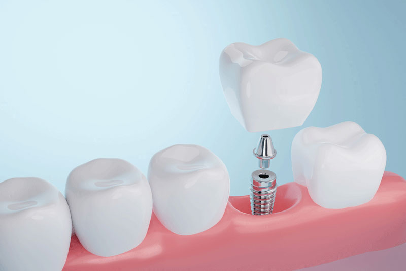 Healthy gums and Dental implant on blue background. 3D rendering.